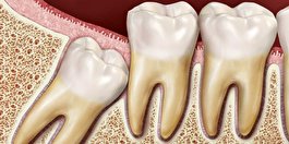 آیا می‌توان دندان عقل را نکشید؟