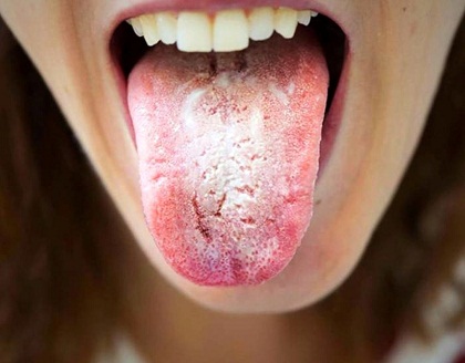 سفید شدن زبان