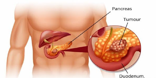سرطان پانکراس