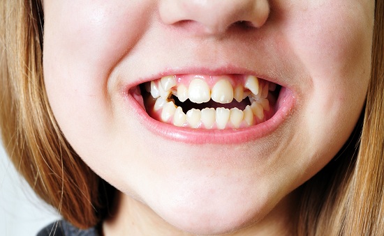 پیشگیری از کج در آمدن دندان